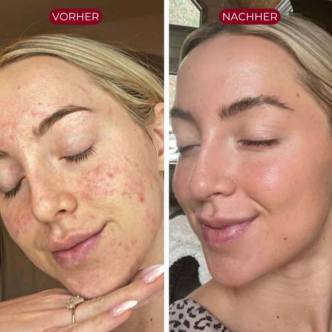 PureSkin™ Serum Duo