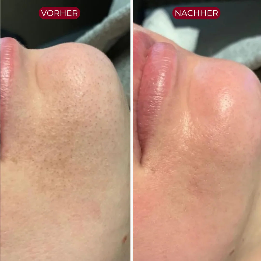 PureSkin™ Serum Duo