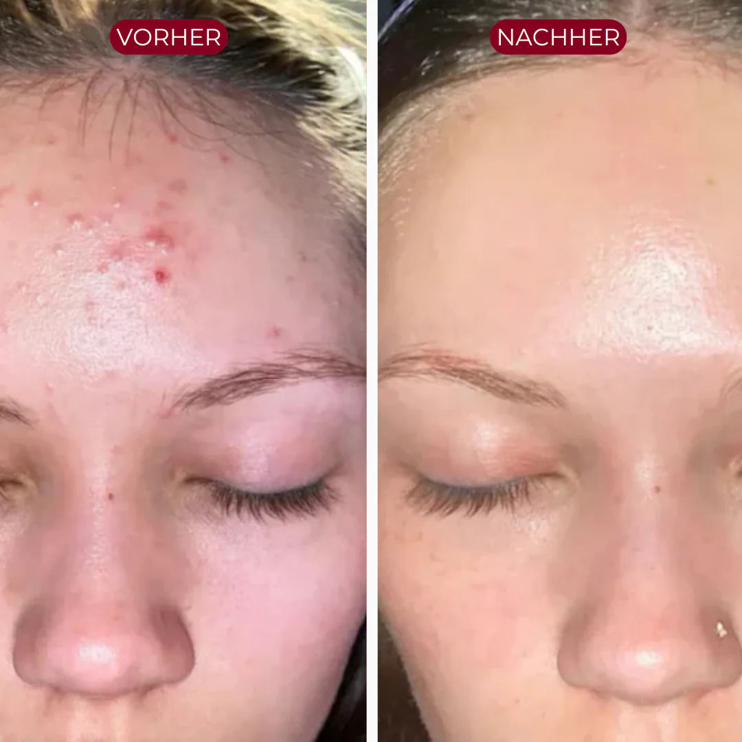 PureSkin™ Serum Duo